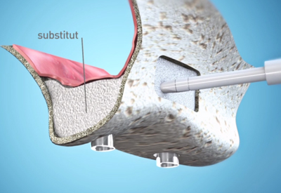 Dentiste Athis-Mons - Sinus lift