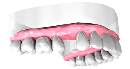 Dentiste Athis-Mons - Implant dentaire