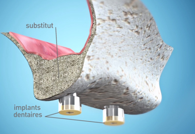 Dentiste Athis-Mons - Implant dentaire