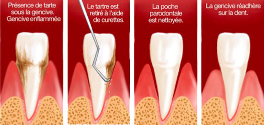 Dentiste Athis-Mons - parodontologie