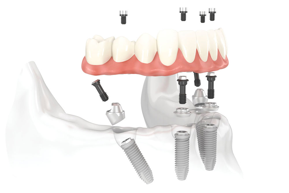 Dentiste Athis-Mons - All on 4