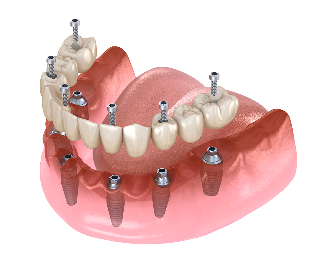 Dentiste Athis-Mons - Implant dentaire