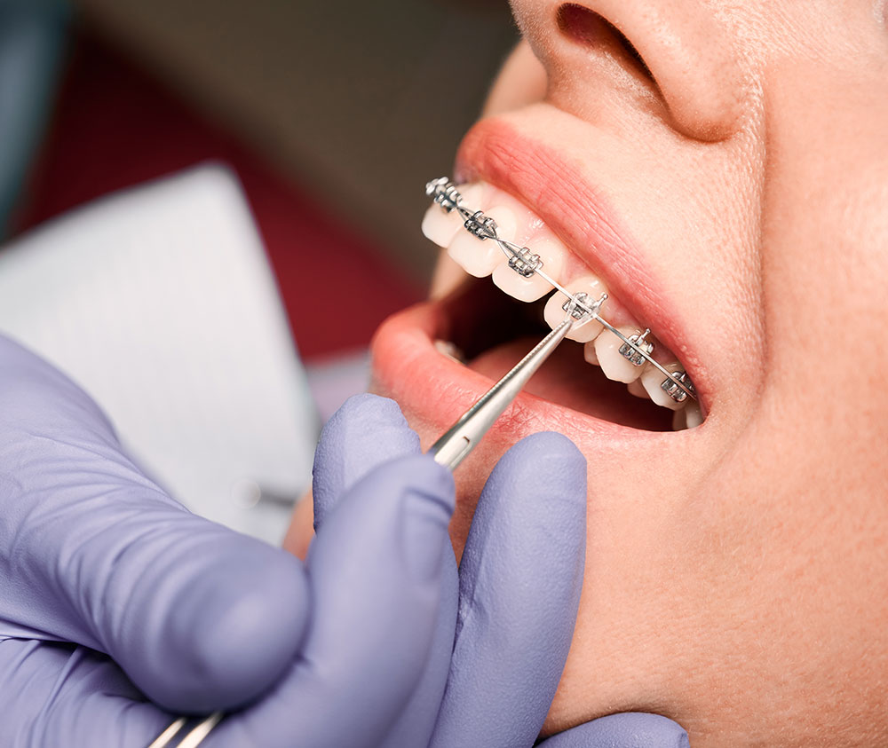 Dentiste Athis-Mons - Orthodontie