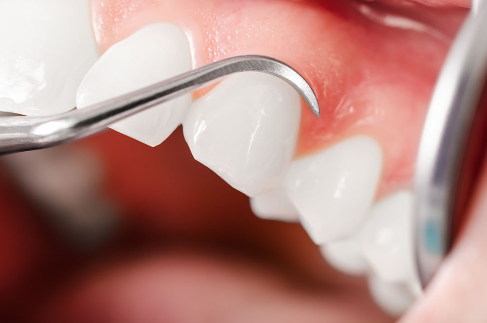 Dentiste Athis-Mons - Parodontologie