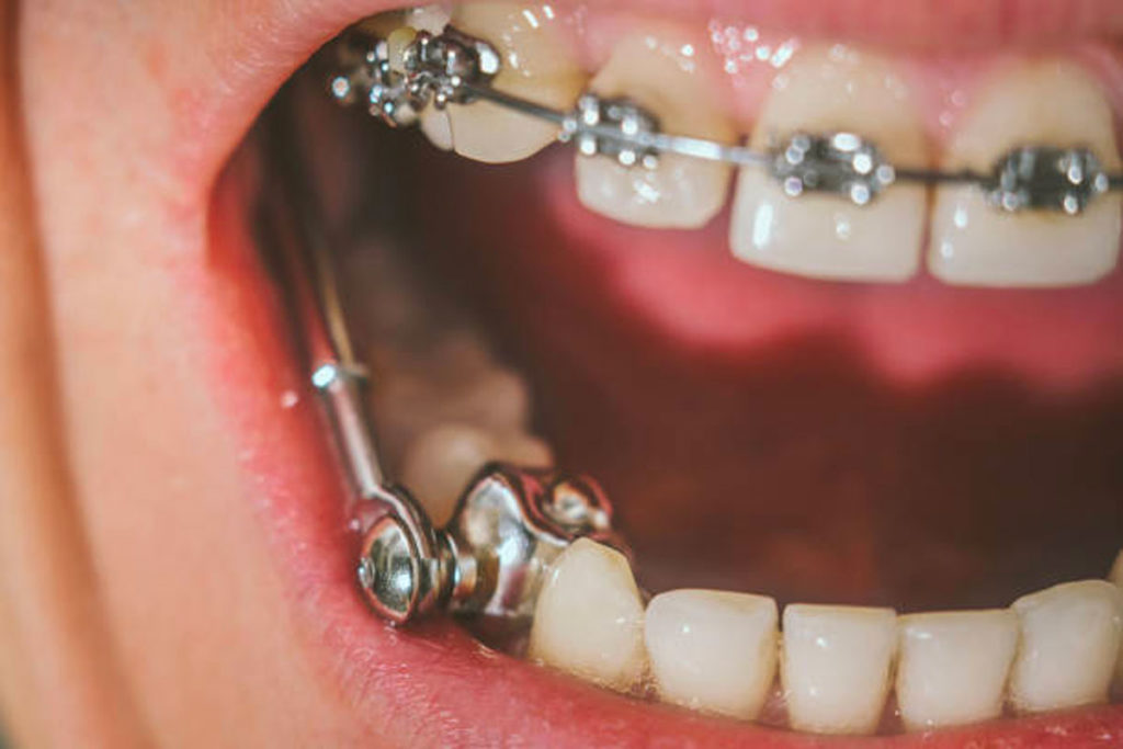 Dentiste Athis-Mons - Orthodontie