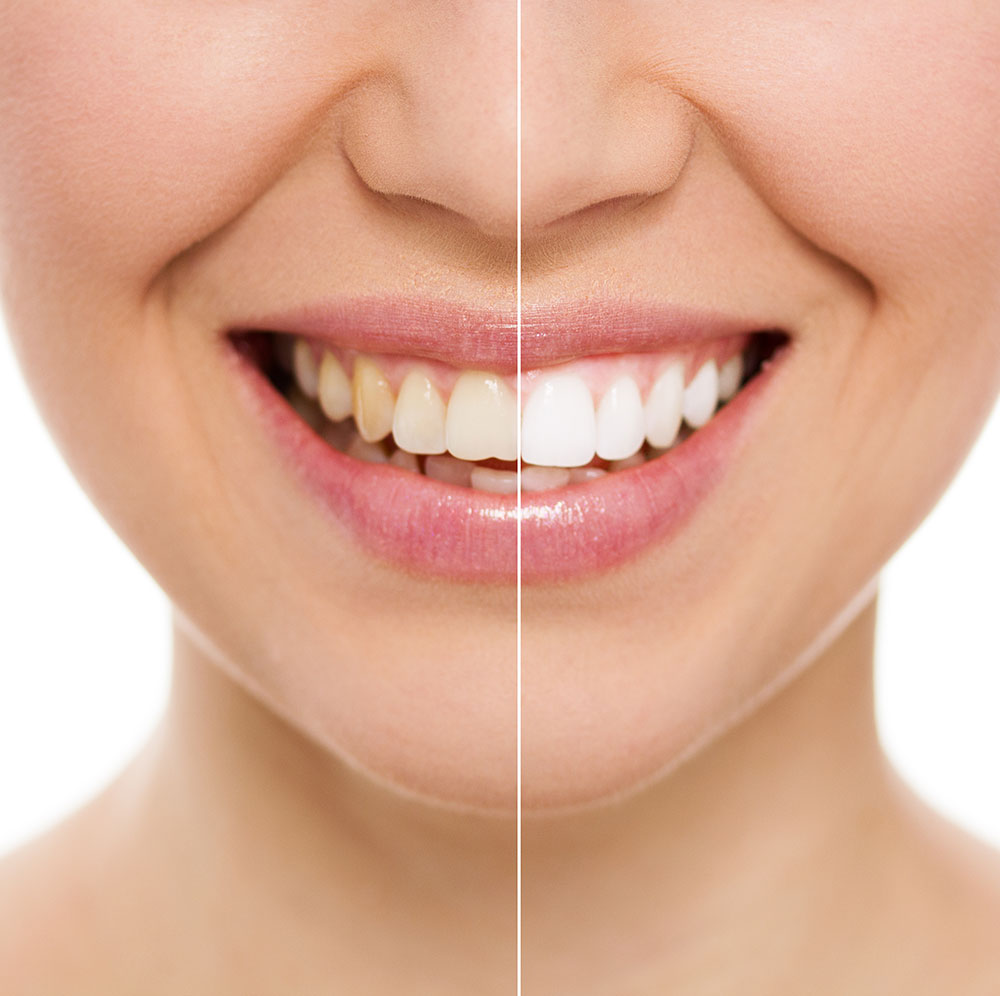 Dentiste Athis-Mons - Éclaircissement dentaire