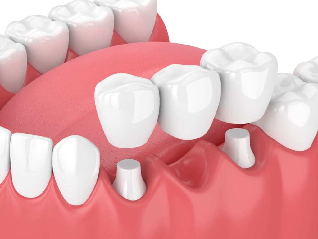 Dentiste Athis-Mons - Bridge
