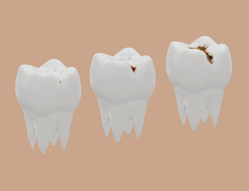 Dentiste Athis-Mons - Carie dentaire