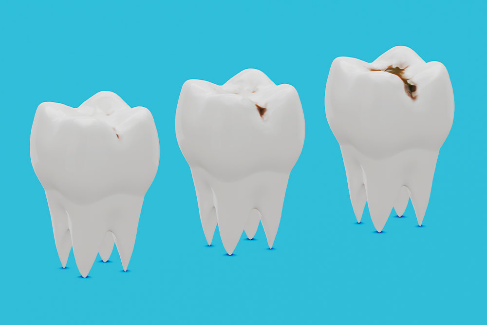 Dentiste Athis-Mons - Carie dentaire