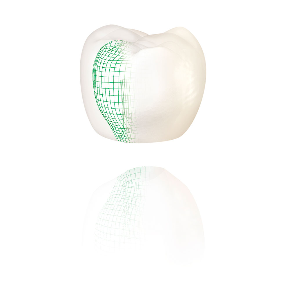 Dentiste Athis-Mons - Couronne dentaire