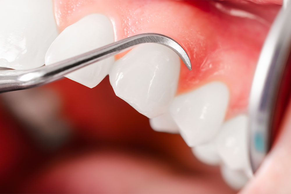Dentiste Athis-Mons - Curetage parodontal