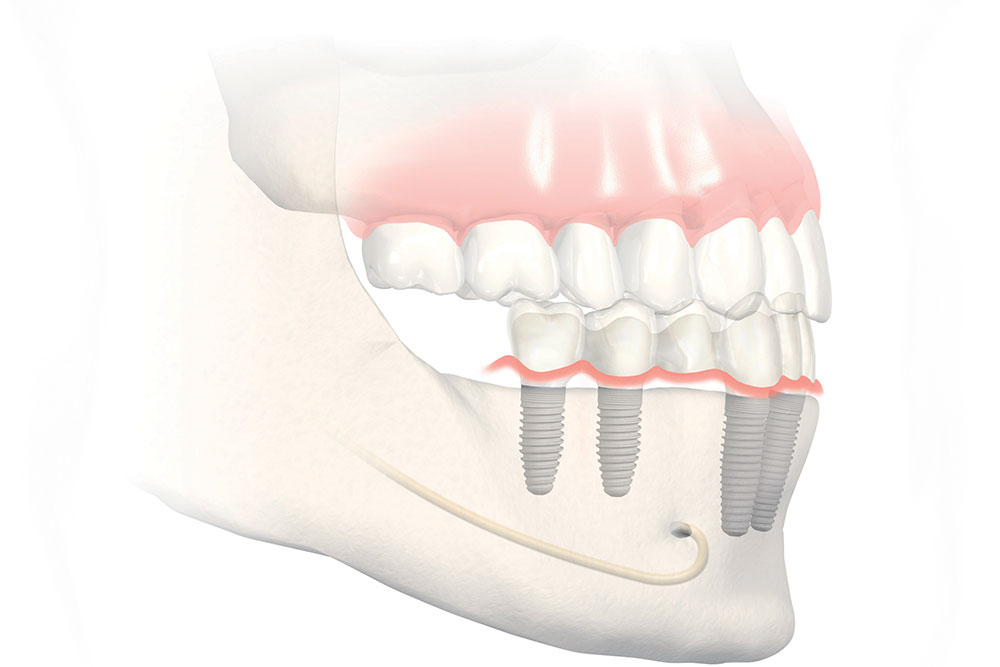 Dentiste Athis-Mons - implant dentaire