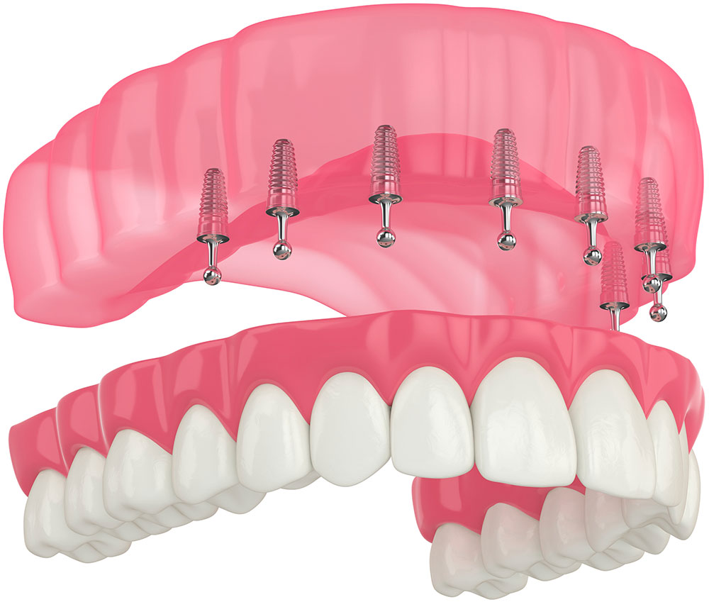 Dentiste Athis-Mons - Prothese complete sur implants