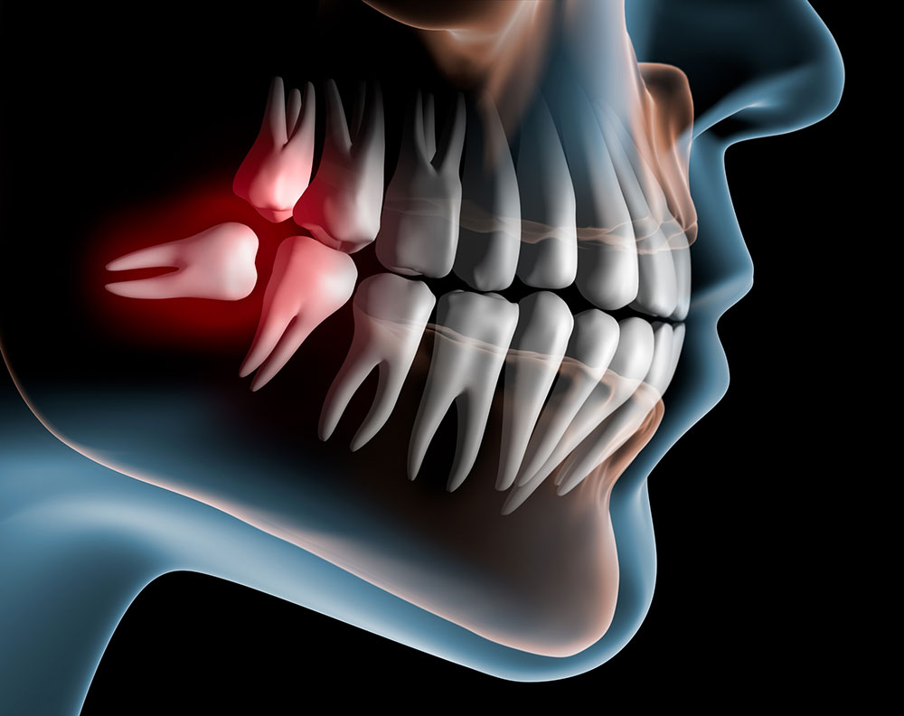 Dentiste Athis-Mons - Dent de sagesse