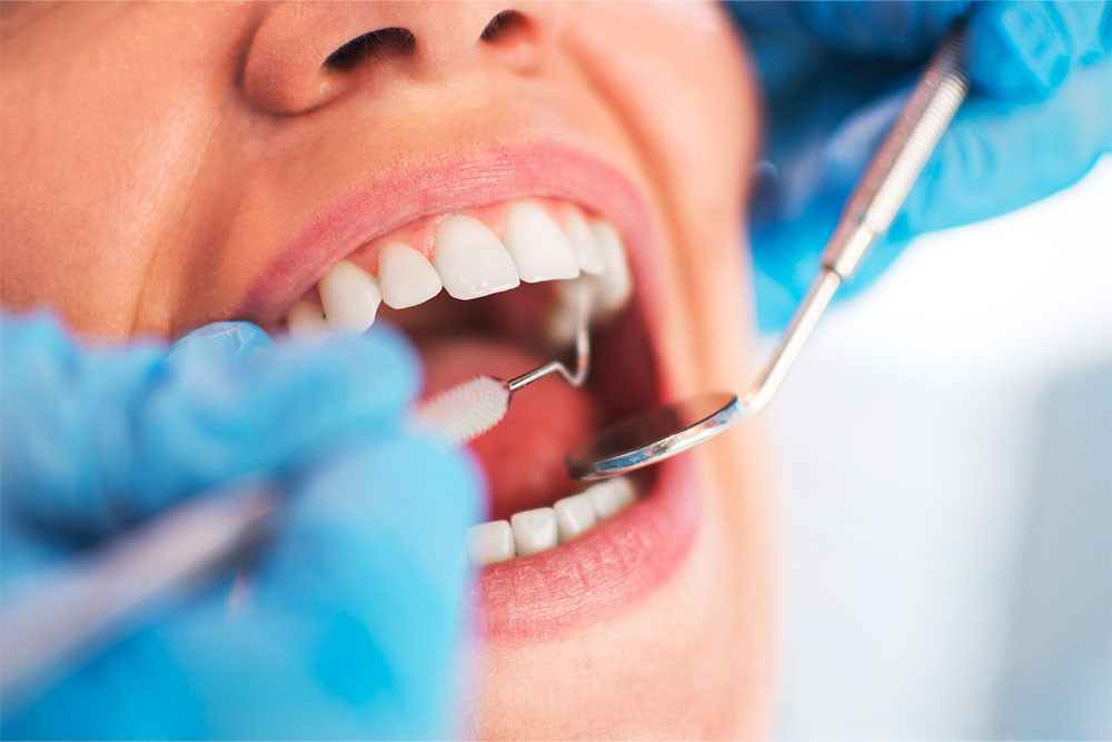 Dentiste Athis-Mons - Détartrage