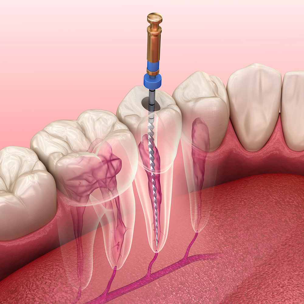 Dentiste Athis-Mons - Endodontie
