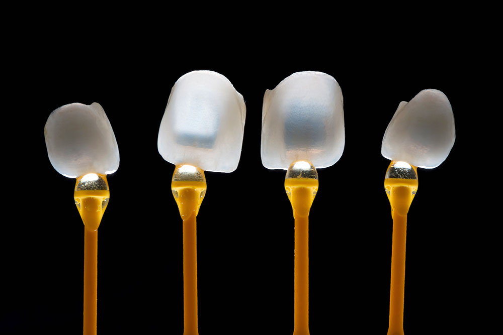 Dentiste Athis-Mons - Facette dentaire