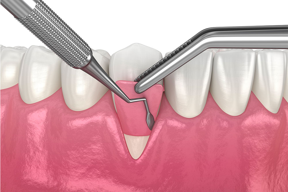 Dentiste Athis-Mons - Greffe de gencive