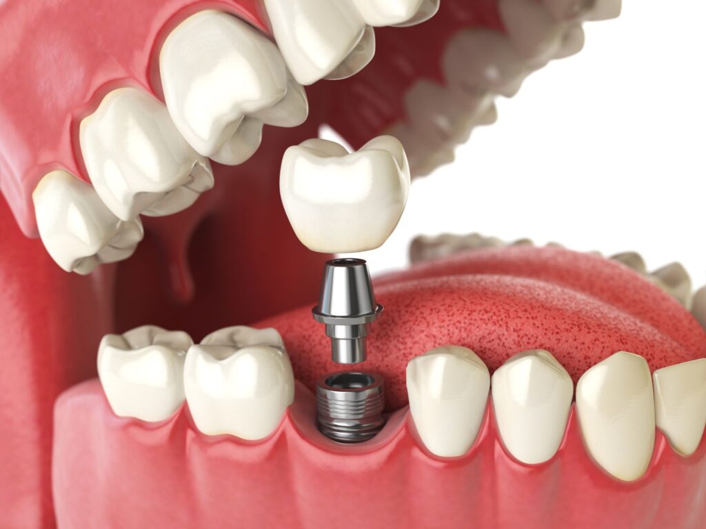 Dentiste Athis-Mons - Implant dentaire