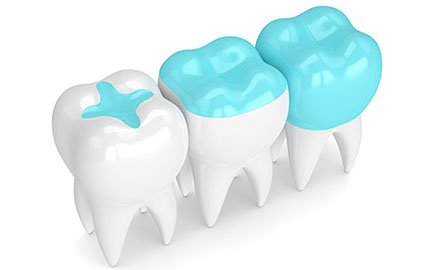 Dentiste Athis-Mons - inlay onlay