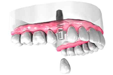 Dentiste Athis-Mons - Implant dentaire