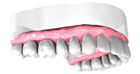 Dentiste Athis-Mons - Implant dentaire